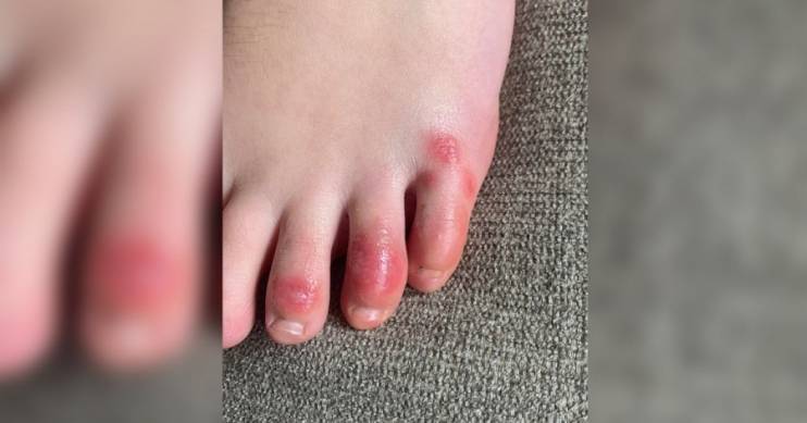 Что такое «коронавирусные пальцы» - ранние признаки инфекции, которые отмечаются даже у бессимптомных пациентов