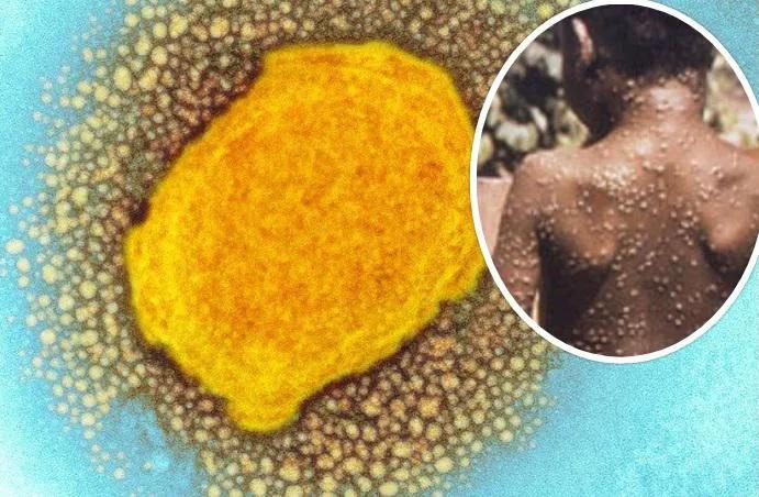 В нескольких странах мира выявлено инфекционное заболевание оспа обезьян – каковы симптомы и есть ли опасность его широкого распространения?