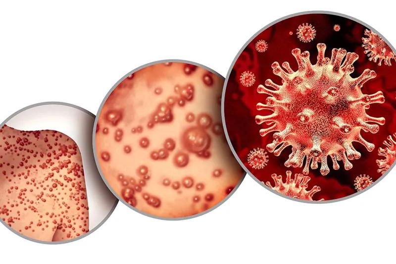 ВОЗ объявила глобальную чрезвычайную ситуацию в связи с «оспой обезьян»