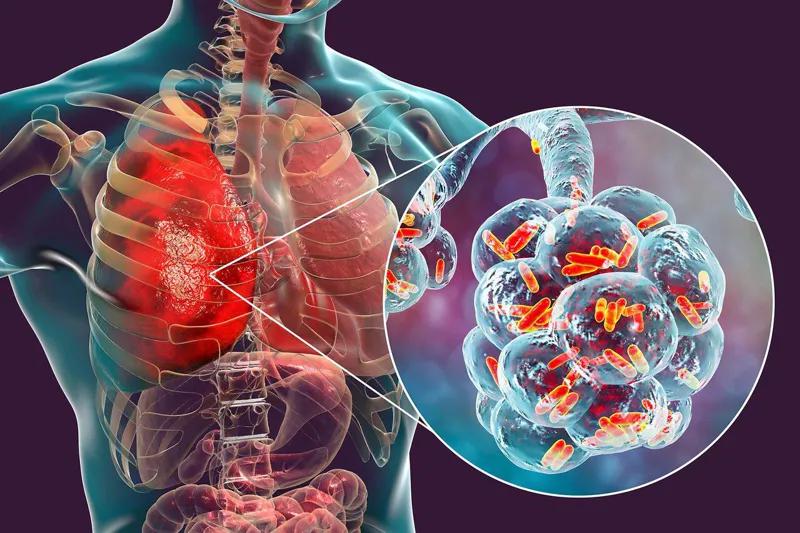 В Польше от легионеллеза умер 8-й человек – что известно об инфекции, каковы ее симптомы и насколько она опасна