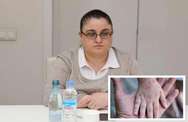 Для начала «оспы обезьян» характерны гриппоподобные симптомы» - Для кого опасен вирус, в связи с которым ВОЗ объявила чрезвычайное положение