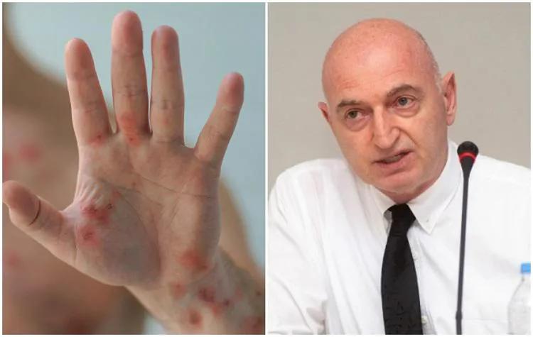 Все родившиеся до 1980 года, кто вакцинирован  от оспы, имеют определенную защиту от «оспы обезьян» - Иване Чхаидзе