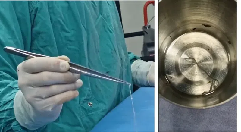 Из мозга пациентки в Грузии извлечен живой паразит длиной 15 см: «Редкий и, возможно, первый случай в истории медицины»