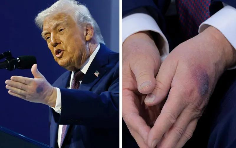 Что случилось с руками Трампа и почему у него синяки? - «Врач мне сказал, что...»
